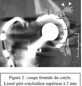 Figure 2 : coupe frontale du cotyle.  Liseré péri-cotyloïdien supérieur à 2 mm 