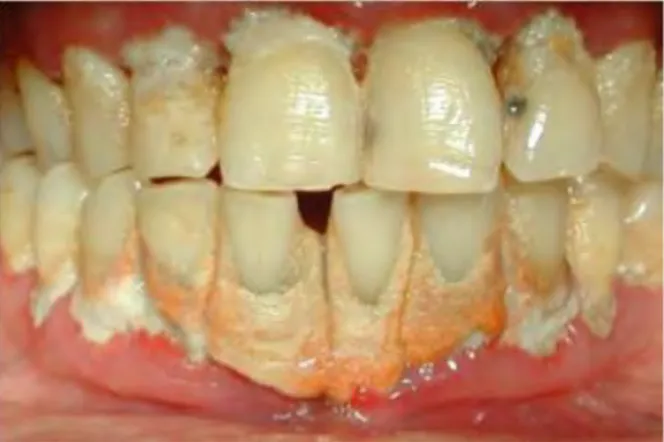 Figure 4 Maladie parodontale (source Dr Georgelin-Gurgel) 