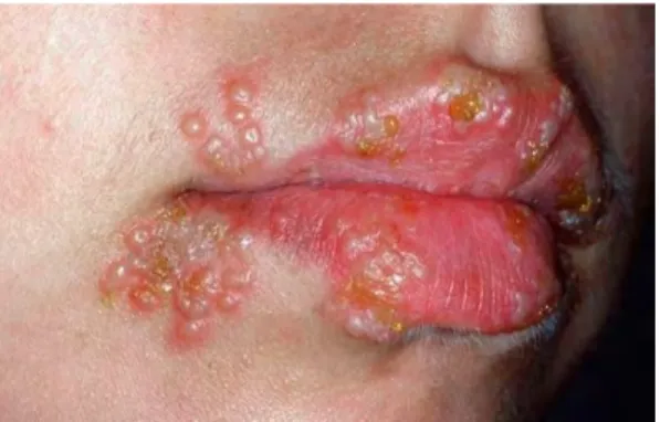 Figure 10 Herpes labial (source Internet)