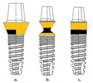 Illustration 3: Schéma des différents profils du pilier  prothétique. (30)