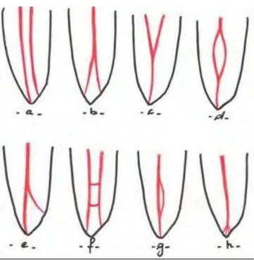 Figure 8 : Configurations canalaires retrouvées dans la classification de Carames de Aprile 