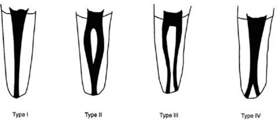 Figure 10 : Configurations canalaires retrouvées dans la classification de Weine