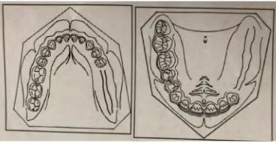 Figure 19 : Schémas d’arcades maxillaire et mandibulaire en classe II de Kennedy (14) 