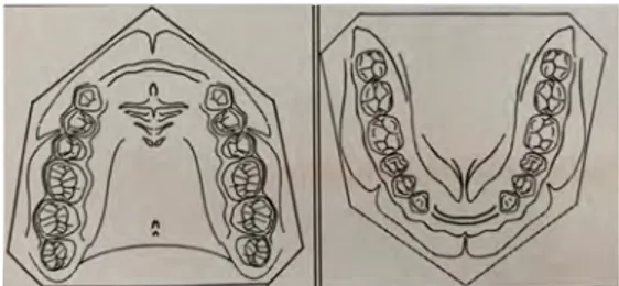 Figure 21 : Schémas d’arcades maxillaire et mandibulaire en classe IV de Kennedy (14) 