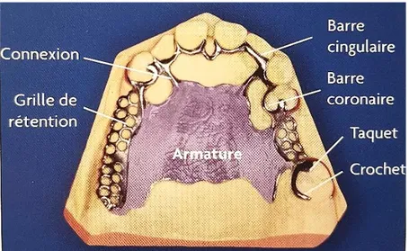 Figure 8 : Légende des éléments constitutifs d’une  prothèse partielle amovible à châssis métallique (7) 