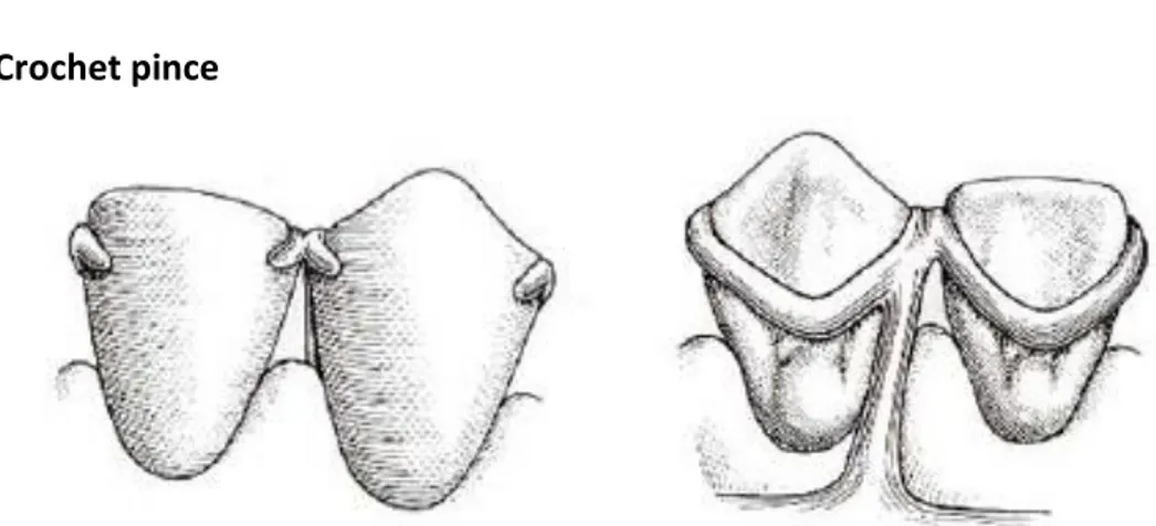 Figure 30 : Schéma d’un crochet pince en vue vestibulaire et palatine (7) 