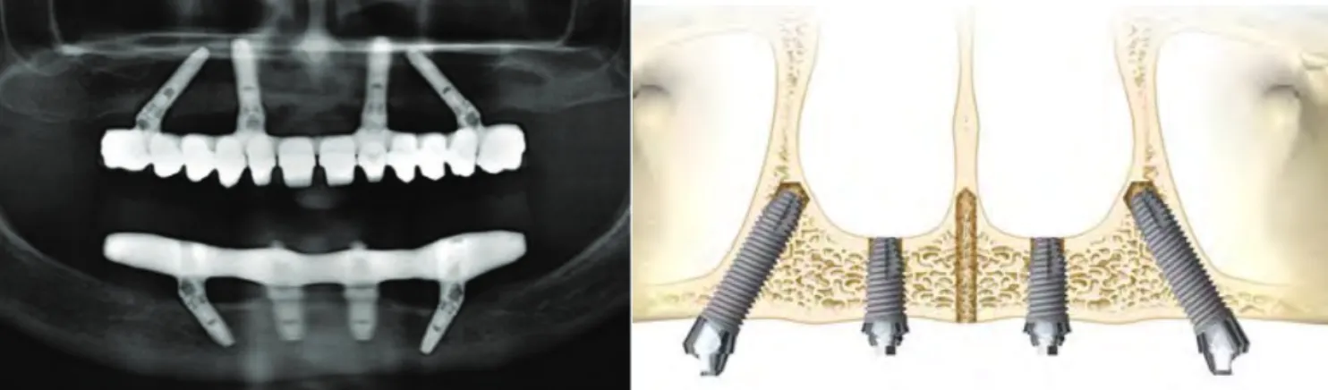 Figure	 9	 et	 10	 :	 Radiographie	 panoramique	 d’une	 réhabilitation	 prothétique	 par	 implants	All	on	Four	au	maxillaire	et	à	la	mandibule.	Illustration	du	concept	All	on	Four.	