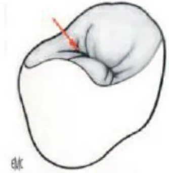 Figure 4 : naissance du sillon par la réunion des versants internes cuspidiens [13]
