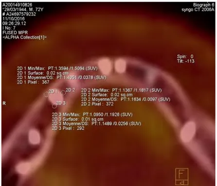 Figure 3 : mesure de la SUV péri-implantaire autour d’un implant mandibulaire. 