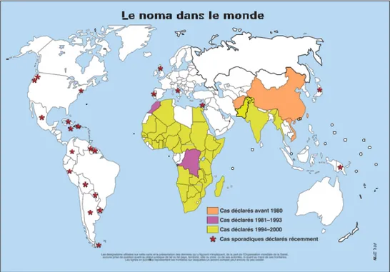 Figure 4 Cas  de  noma  signalés  dans  le  monde. (Source: Programme OMS de Santé Bucco- 