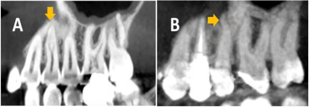 Fig.  12 –  Coupe  CBCT 