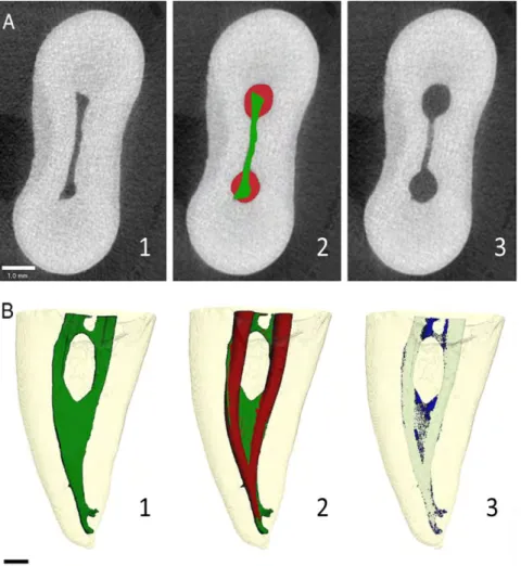 Fig.  19  –  Analyses  micro-CT  d’une  racine  mésiale  d’une  molaire  mandibulaire  mise  en 