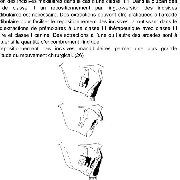 Figure  22 :  En  haut :  mouvement  d’avancée  mandibulaire  chirurgical  sur  des  arcades  non- non-décompensées