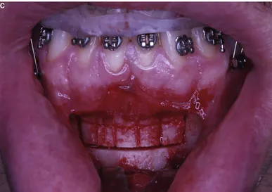 Figure 24 : Vue en per-opératoire d’une ostéotomie segmentaire mandibulaire. Le phénomène  d’accélération régional est favorisé par la réalisation de corticotomies (28) 
