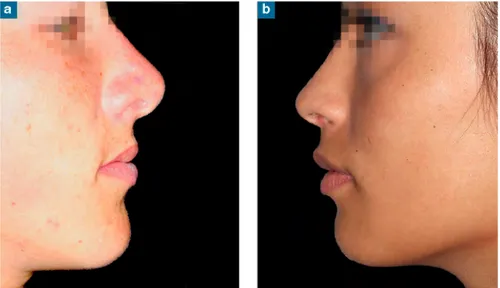 Figure 30 : La perception du volume de la lèvre supérieure et du contour  labial est influencée par la forme du nez (18) 