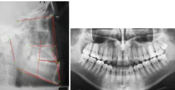 Figure 33 : Radiographies de départ. A gauche : Téléradiograhie de profil avec tracé IBO