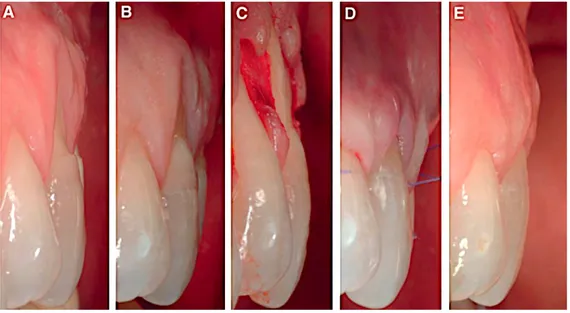 Figure	28	A)	LCNC	de	type	4,	B)	coronoplastie	additive	de	la	portion	coronaire,	C)	levée	du	 lambeau	et	coronoplastie	soustractive	de	la	portion	radiculaire,	D)	repositionnement	du	 lambeau	coronairement	et	sutures,	E)	Post-cicatriciel	(Zucchelli	2011) 
