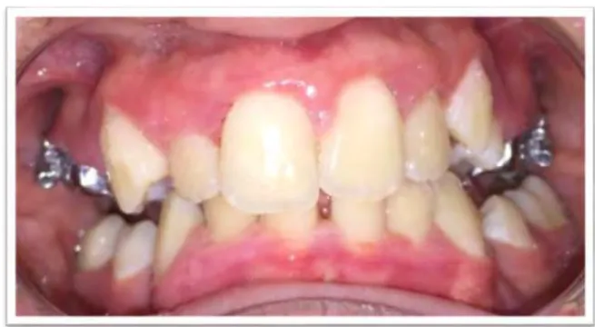 Figure 13: Fin de la première phase de traitement. 