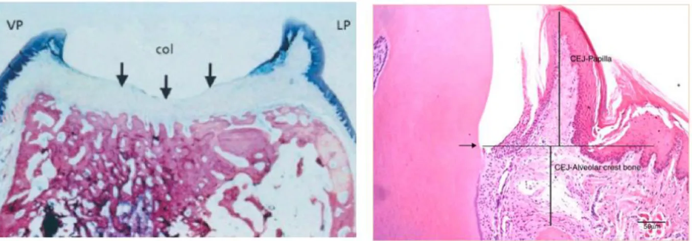 Figure 4 - A gauche : coupe histologique de papille mésiale en regard d'une  première molaire mandibulaire, la flèche représentant la jonction émail-cément