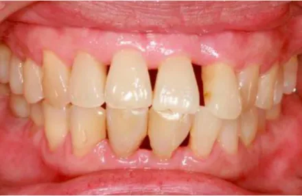 Figure 12 - Trous noirs suite à une pathologie parodontale, aggravée par une  anatomie des dents triangulaire