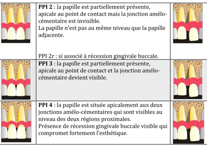 Tableau 4 - Classification de Cardaropoli. 