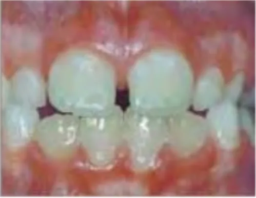 Figure 7 : défaut amélaire grade I par Rashid et al (34) 