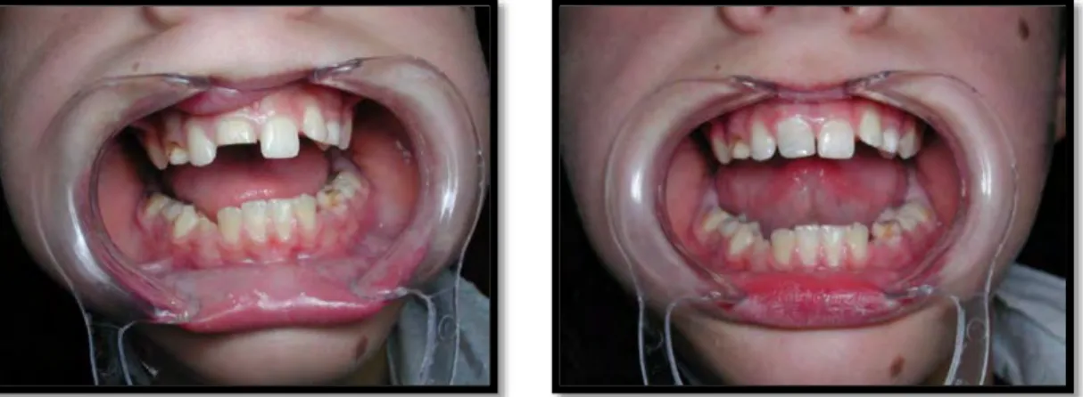 Figure 2 : Reconstitution d’une fracture coronaire par composite à l’aide d’une attelle  métallique intra dentaire