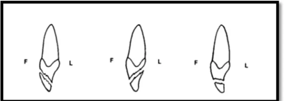 Figure 4 : Les différents types de fracture coronaire : B_C_A. D’après Jeffrey A et al