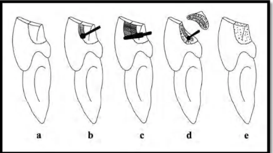 Figure 8 : Les différentes techniques de restauration d’une dent fracturée : A : collage  seul, B : chanfrein ; C : sur-contour ; D : rainure interne ; E : restauration composite