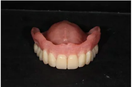 Figure 5 - Etat initial de la prothèse maxillaire. 