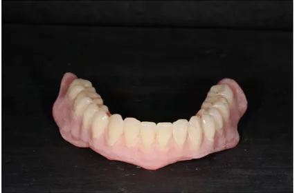 Figure 7 - Prothèse mandibulaire dépolie et sablée. Vue de face. 