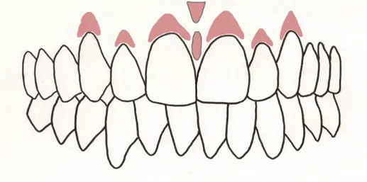 Figure 12 - Schéma de la 1ère étape du maquillage au maxillaire 