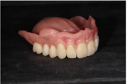 Figure 15 - Application du Satins Red en antérieur, prothèse maxillaire. Vue de  trois quarts