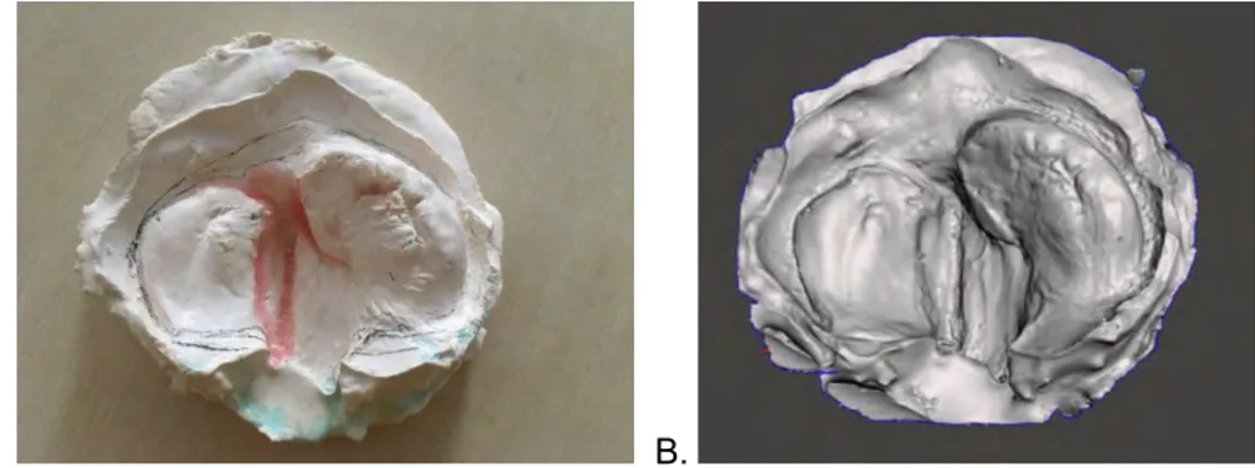 Figure 8 A. Empreinte coulée en plâtre avec punch de cire. B. Empreinte optique avec caméra Emerald  Planmeca