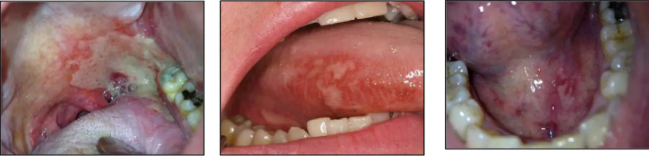 Figure 9: Mucite de grade III [20] Figure 11: Mucite grade II [20] Figure 10: Mucite grade I [20] 