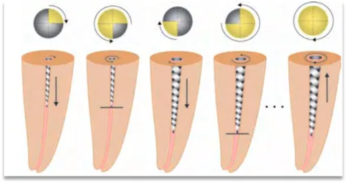 Figure : séquence du mouvement décrit par Roane ; Rotation ¼ de tour avec pression apicale,  ¾ de tour pour section dentinaire, tour horaire pour remonter les débris jusqu’au retrait pour  nettoyage et irrigation