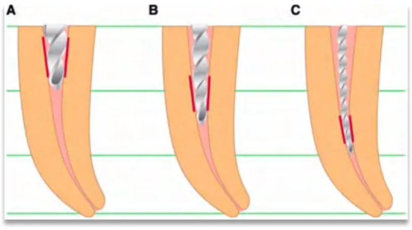 Figure  :  schématisation  de  la  technique  crown  down,  l’instrument  s’engage  dans  la  dentine  radiculaire sur sa portion apicale (zone rouge) réduisant la surface de contact, le torque et le  risque de fracture