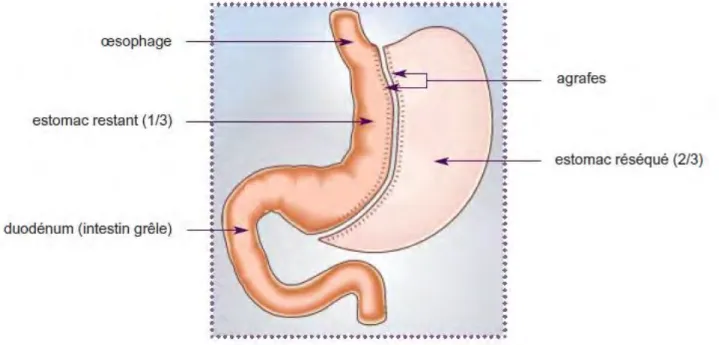 Figure 4 : Schéma de la gastrectomie longitudinale (sleeve). 