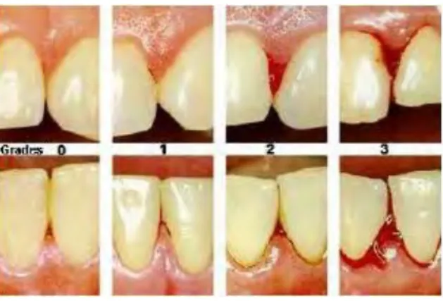 Figure 11 : Les différents stades de l’inflammation gingivale selon Löe &amp; Silness