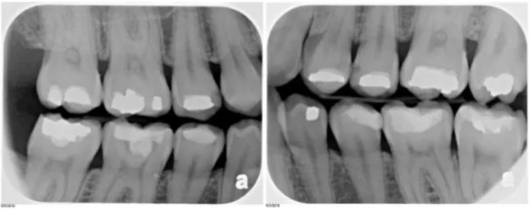 Figure 2 : Bitewing des deux côtés, montrant plusieurs lésions carieuses 