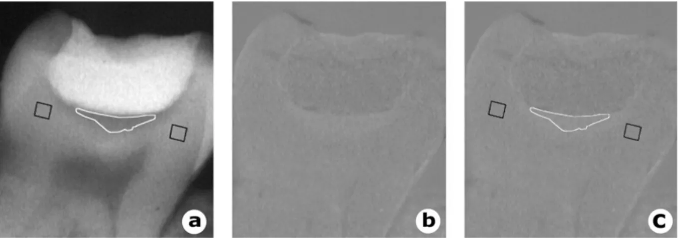 Figure 6 : Radio prise lors de la situation initiale (a), image traitée lors du contrôle à 6 mois  (b) et superposition des deux couches pour l’analyse de la zone de reminéralisation 