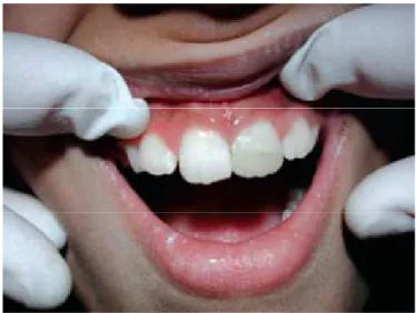 Figure 9 : Discoloration cervicale due au MTA 55