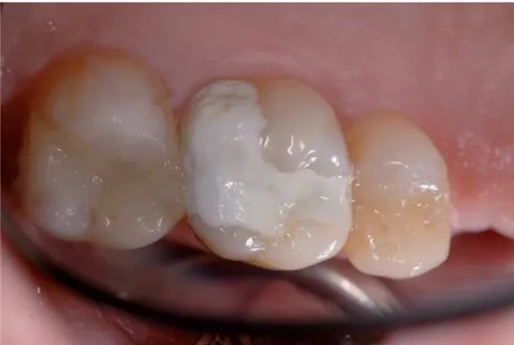 Figure 10 : Utilisation de Biodentine® en restauration temporaire 