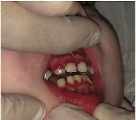 Figure 3 : Photo d’un enfant atteint de gingivite hémorragique (18) 