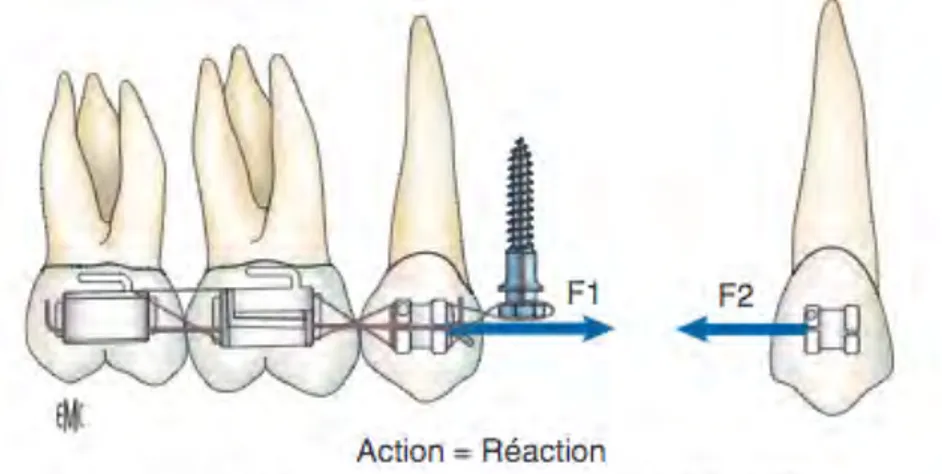 Figure	
  6	
  :	
  Ancrage	
  indirect	
  par	
  minivis	
  (F1=F2)	
  (13)	
  