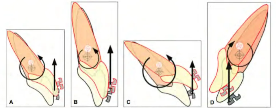 Figure	
  9	
  :	
  Effet	
  de	
  l'inclinaison	
  et	
  de	
  la	
  localisation	
  du	
  point	
  d'application	
  de	
  la	
  force	
  sur	
  le	
  mouvement	
   dentaire.	
  Une	
  force	
  intrusive	
  sur	
  l'incisive	
  avec	
  (A)	
  un	
  axe	
  normal,	
  (B)	
  un	
  axe	
  droit,	
  (C)	
  un	
  axe	
  horizontal,	
  (D)	
  