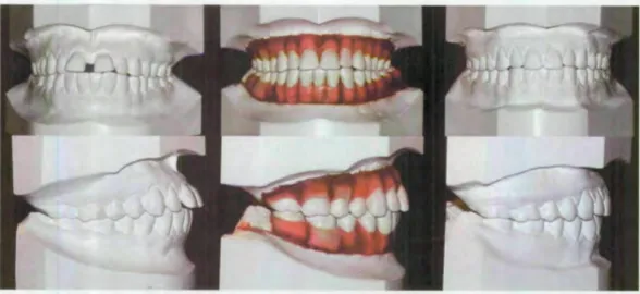 Figure	
  15	
  :	
  Set-­‐up	
  avec	
  extraction	
  de	
  l'incisive	
  mandibulaire	
  (34) 