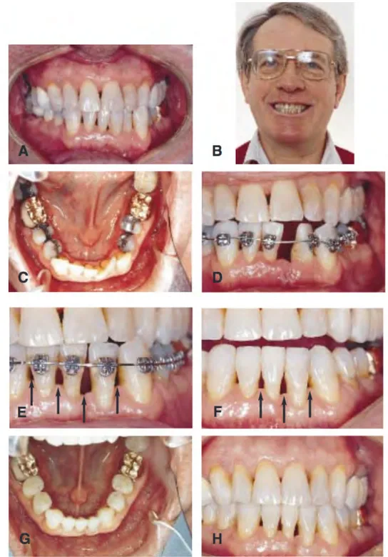 Figure	
  16	
  :	
  cas	
  extrait	
  d'un	
  article	
  du	
  Dr.	
  Zacchrisson	
   	
  