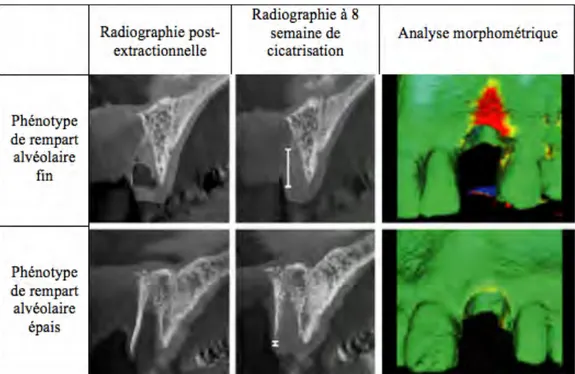 Figure 12 : Analyse radiographique et morphométrique de la perte osseuse verticale post-extractionnelle  au niveau du maxillaire antérieur (Chappuis, Araujo et Buser 2017) 