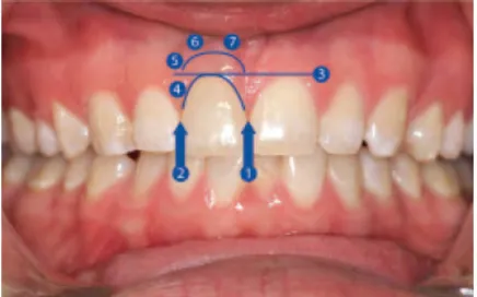 Figure 13 : Les 7 critères du Pink Esthetic Score (Fürhauser et al. 2004) 